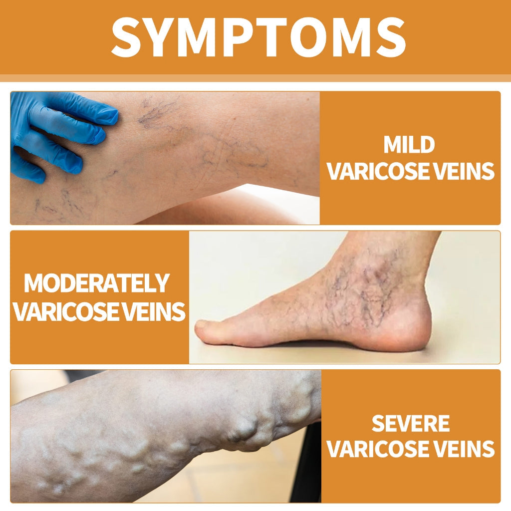 Butikindia - Buy 1 Get 2 Doctor Recommended Turmeric Varicose Vein Relief Spray 🔥 🎁 + 5-Page Exercise & Usage Guide PDF Absolutely FREE FREE